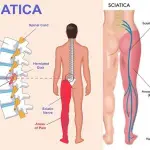 Sciatica Comfort Support Pack | Nerve and Back Supplements in Ghana
