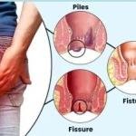 Piles (Kooko) Comfort Support Pack | Natural Supplements for Haemorrhoid Comfort in Ghana